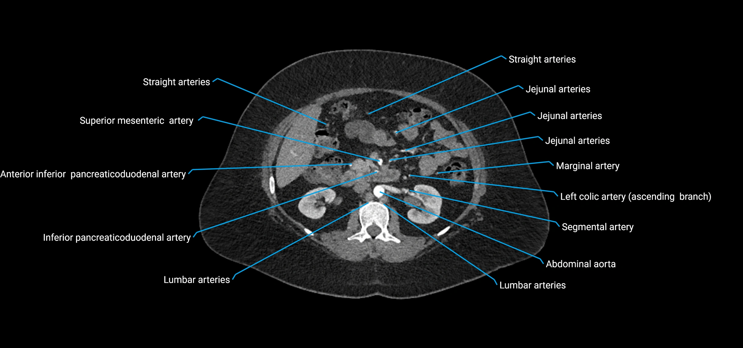 CTA abdomen axial cross sectional anatomy labelled image_78 (2).webp